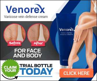 Varicose Veins With Inflammation