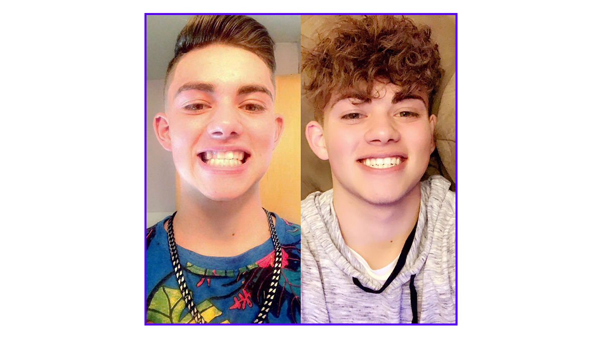 Smile Direct Club Before and After of a teenage boy